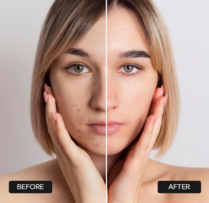 Before and after Morpheus8 facial treatment in Winter Park